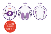 복부 주사 부위 삽화